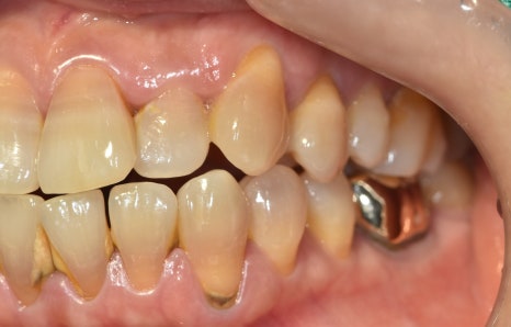 Gangdong-gu Dental Clinic: I Gag So Easily That I’m Too Afraid to Go to the Dentist. Tips to Reduce Gagging image 4