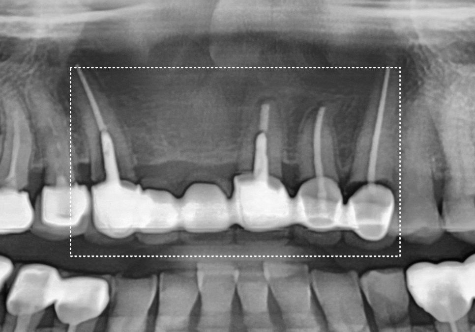 대문니 빠짐, 앞니 빠졌을 때 브릿지와 임플란트 중 나에게 맞는 선택은? 관련 이미지 18