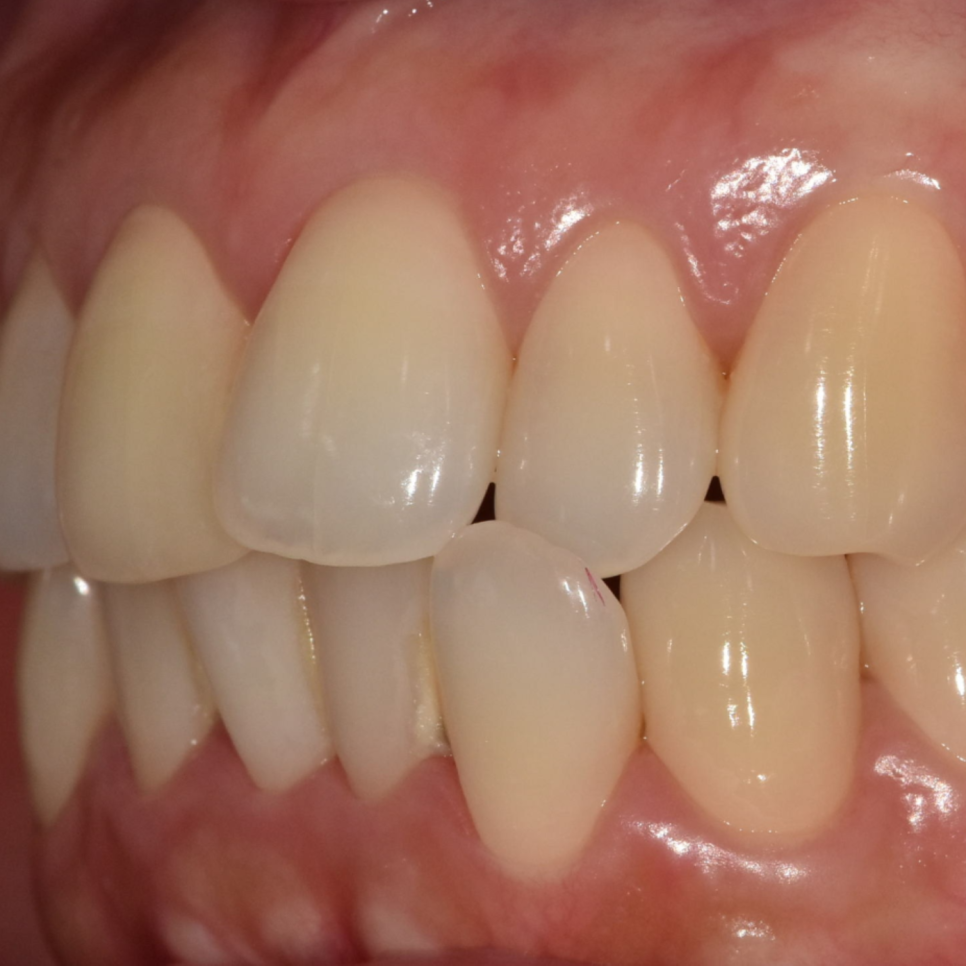 Can Protruding Mouth Be Corrected with Orthodontics Alone, Without Surgery? Sangil-dong Orthodontic Clinic image 2