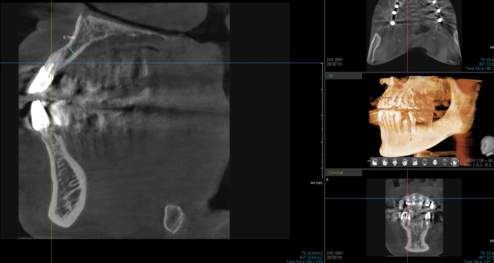 상일동역 치과 부러진 앞니 임플란트로 복구하기 프로젝트 관련 이미지 6