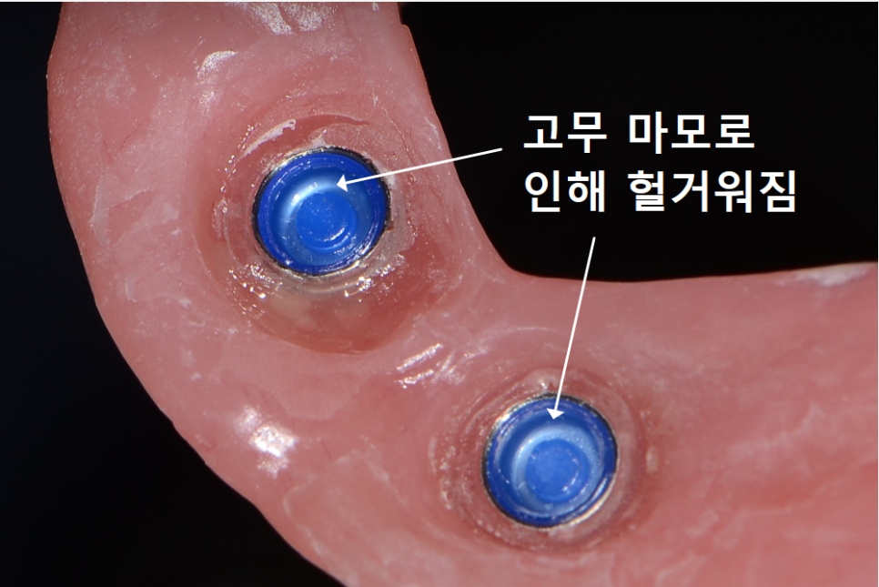 강동구 똑딱이 틀니, 정말 만능일까요? 식사할 때마다 들썩거리는 이유 관련 이미지 7