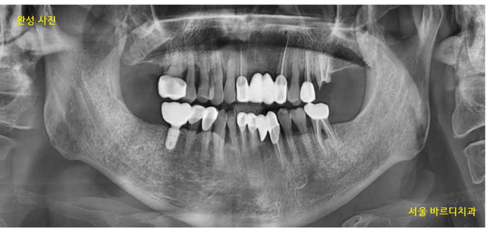오래된 브릿지 보철 제거 후 고덕역 임플란트 교체 케이스 관련 이미지 9