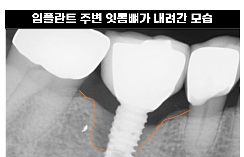 고덕동치과 임플란트 악취 냄새가 나는 이유는? 관련 이미지 6
