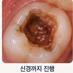 아말감 2차 충치, 안 아파도 교체해야 할 때가 있습니다 관련 이미지 7
