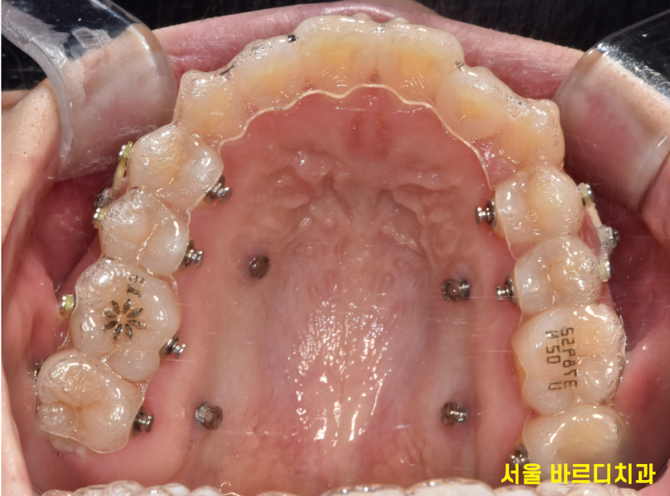 미사 치아교정 군인도 할 수 있을까요?? 투명교정을 추천합니다. 관련 이미지 2