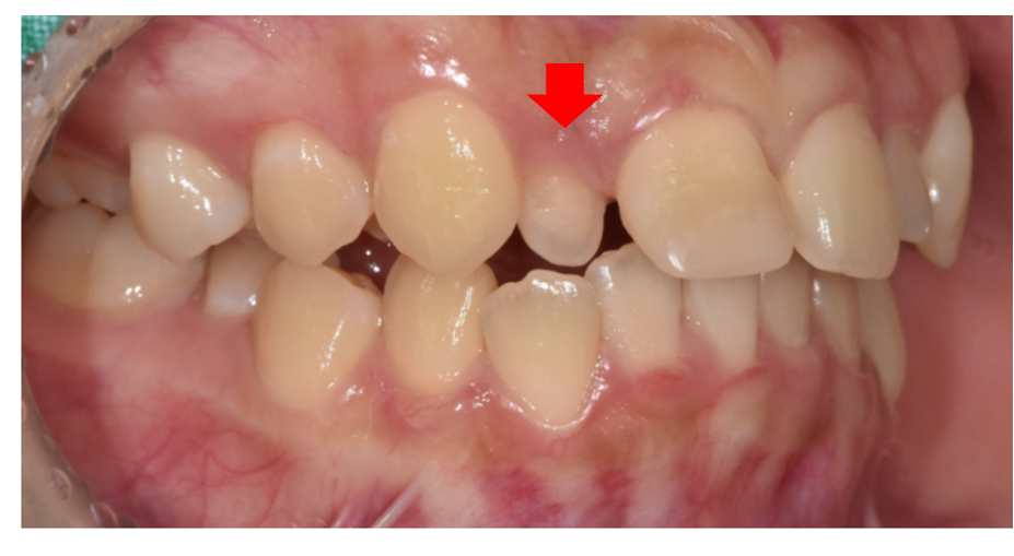 Microdontia Orthodontics Can Restore Balance and Alignment of the Teeth. image 2