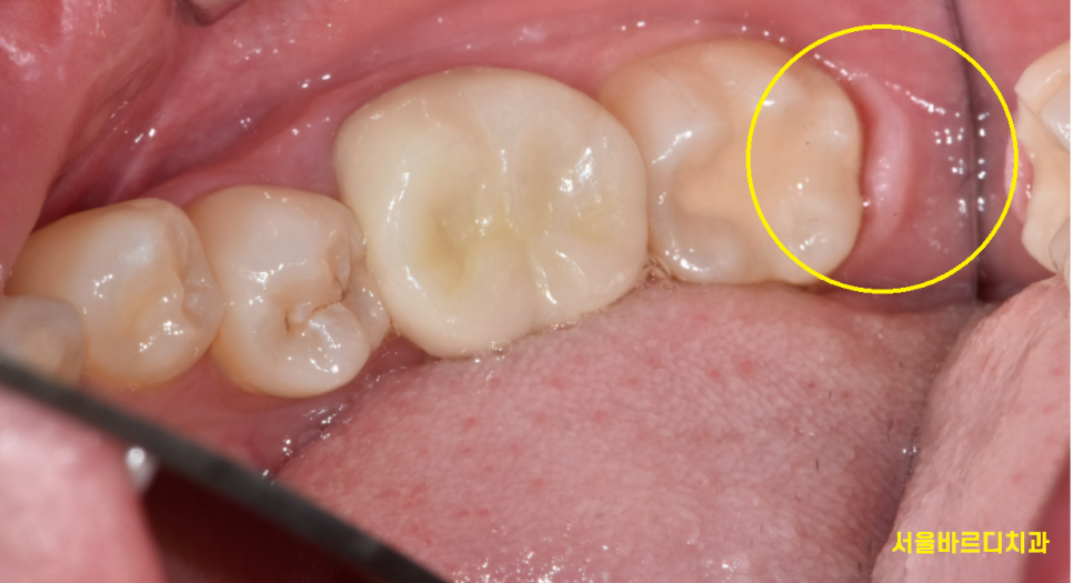 미사 사랑니 뽑아야하나 말아야하나 딱! 정리해드릴께요 관련 이미지 3