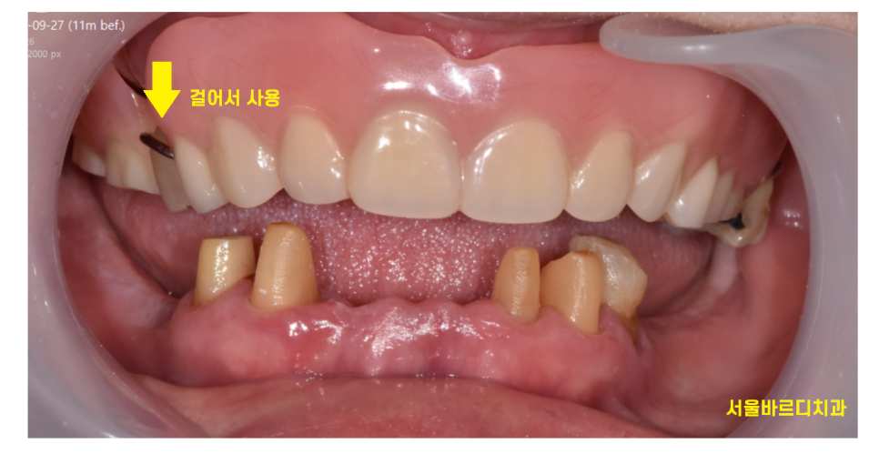 길동 치과 임플란트 틀니 차이 세세하게 대공개 관련 이미지 4