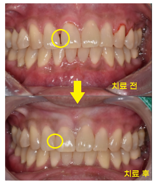 고덕 그라시움 치과 벌어진 앞니 메꾸기 당일 레진으로 치료했습니다. 관련 이미지 7