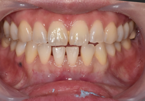 앞니 라미네이트, 치아 시림 고민 덜 수 있는 해결 방법 공개합니다. 관련 이미지 12