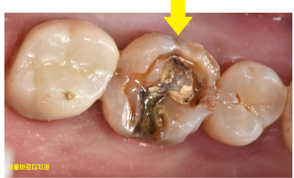 풍산동 치과 골드 인레이 치료했던 치아가 또 충치가 생김. 관련 이미지 5