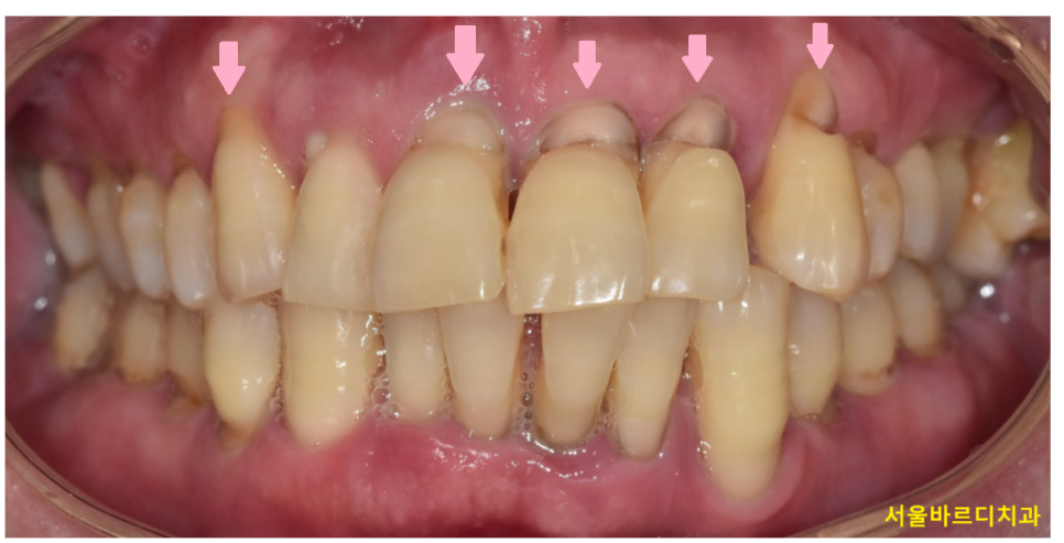 치아 옆면 파임 치경부마모증 치료해주어야하는 이유는? 관련 이미지 2
