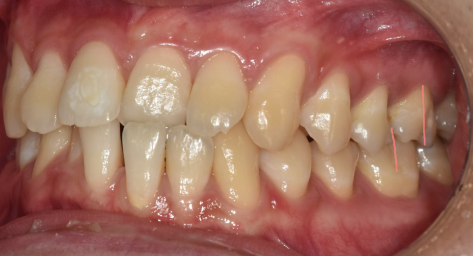 고덕역 교정치과 성인 부정교합 위아래가 거꾸로 물릴때는? 관련 이미지 5