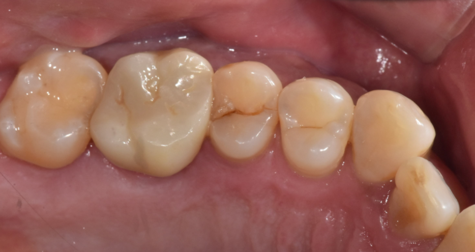 풍산동 치과 어금니 쪼개짐 임플란트를 해야할 때는? 관련 이미지 3