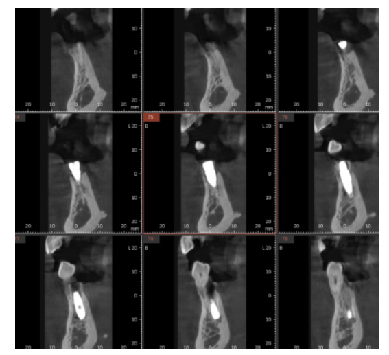 하루만에 임플란트 당일치기가 가능한 조건은?? 관련 이미지 2