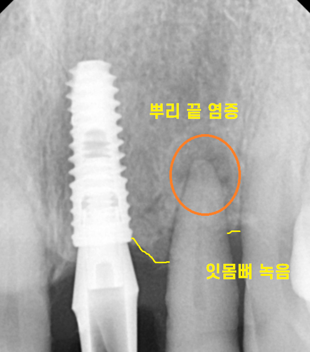 미사 임플란트 보철 새로하고 연결했습니다. 관련 이미지 3