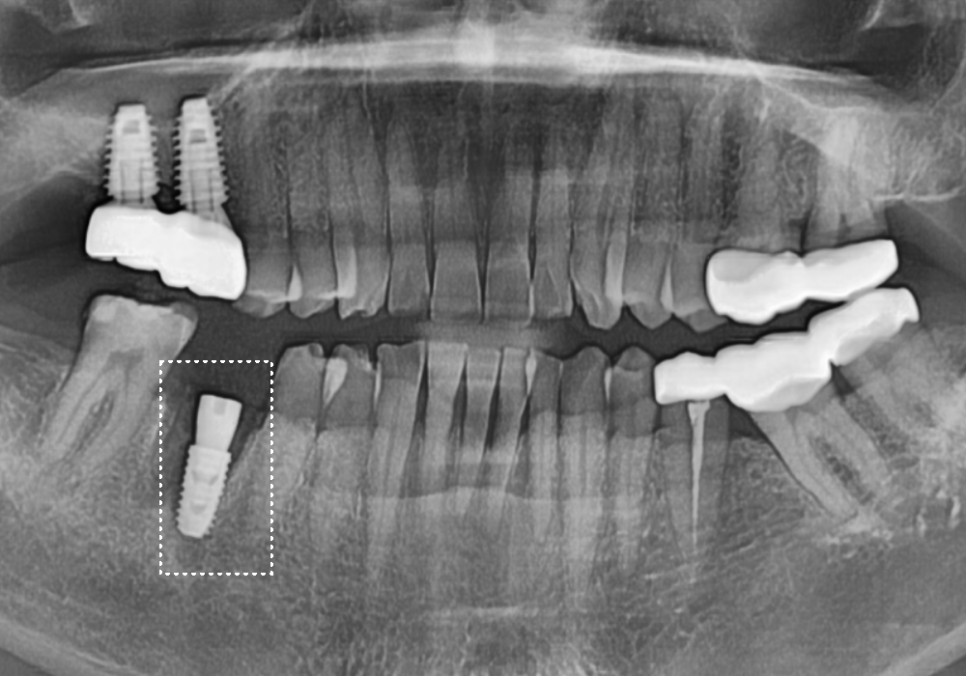 강동구 잇몸 여드름, 이런 상태라면 절대 겉에만 짜는 치료 하지 마세요. 관련 이미지 9