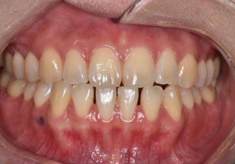 앞니 라미네이트, 치아 시림 고민 덜 수 있는 해결 방법 공개합니다. 관련 이미지 11