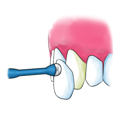 누런니 라미네이트와 미백중 뭐가 더 좋을까요?? 암사동 치과 관련 이미지 4