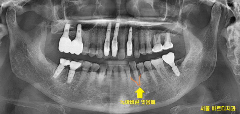 명일동 치과 심미적인 앞니는 하루만에 끝내는 빠른 임플란트로 하세요!! 관련 이미지 2