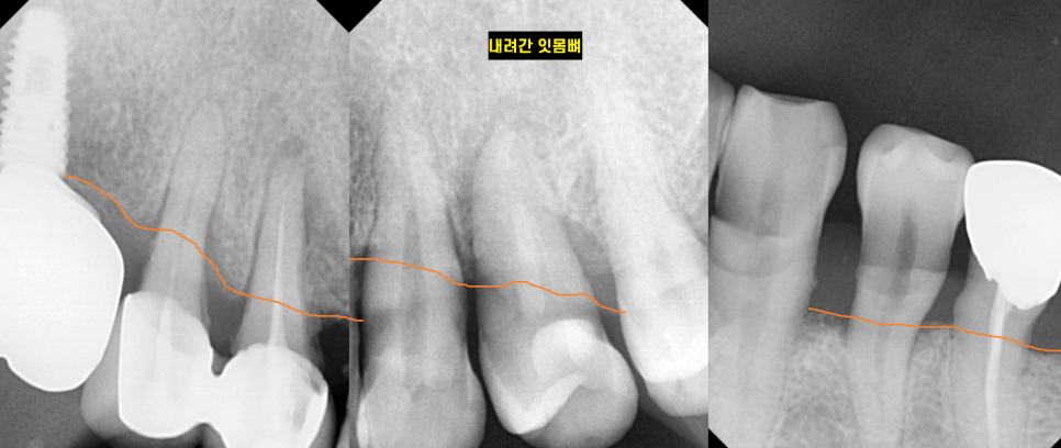 강일동 임플란트 위아래 치아 흔들림과 통증이 있을 때 방법은? 관련 이미지 4