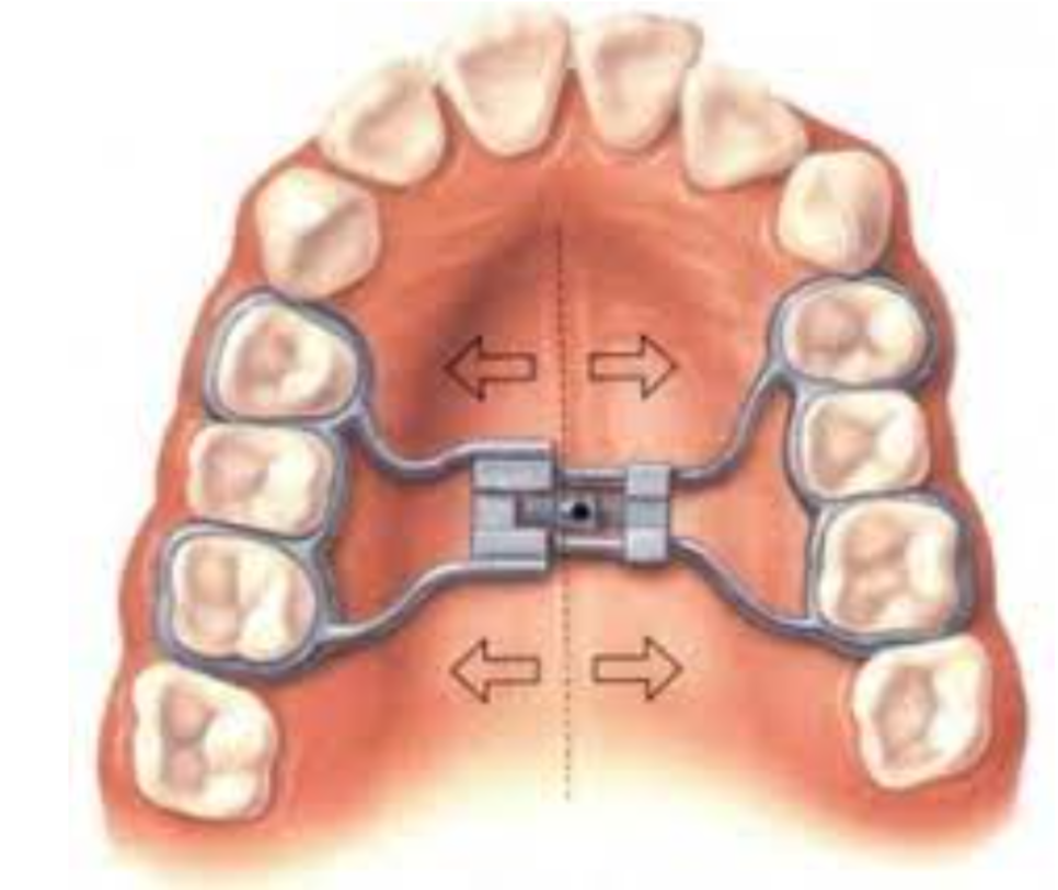 소아 악궁확장 RPE장치란? 성장기 1차 교정 진행해야할 때 관련 이미지 6