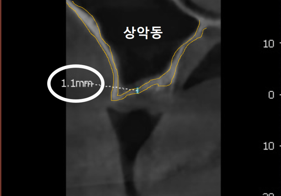 얇은 잇몸뼈 때문에 임플란트 하기 힘들다면? 저희는 관련 이미지 5