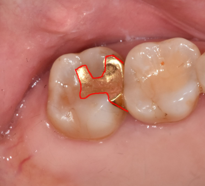 치실 안쓰면 이렇게 됩니다!!  치아 사이 충치 인레이 치료 관련 이미지 6