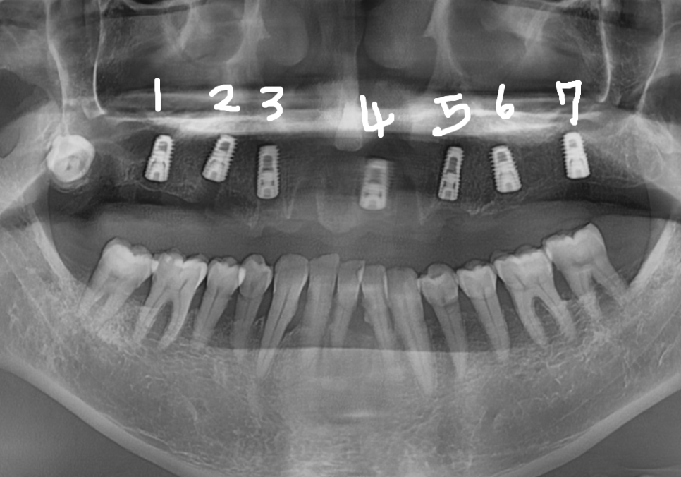 위 턱 전체 임플란트 vs 부분 틀니, 나에게 꼭 필요한 치료법 찾기 관련 이미지 7