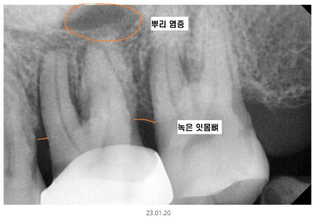 천호동 치과 과잉 진료를 피하는 방법 대공개 관련 이미지 4