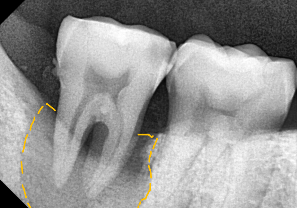 어금니 구멍, 충치 솔직하게 말씀드립니다. 치과 공포증으로 미루신 분들 필독 관련 이미지 5