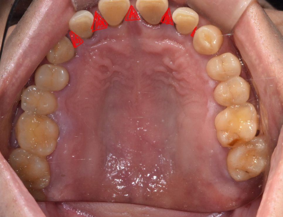 앞니 사이 간격 넓어짐 치아가 벌어져서 보기 싫을 때 크라운 치료 관련 이미지 4