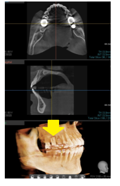 고덕역 임플란트 잇몸 뾰루지 뼈이식 두번 하여 해결했습니다. 관련 이미지 5
