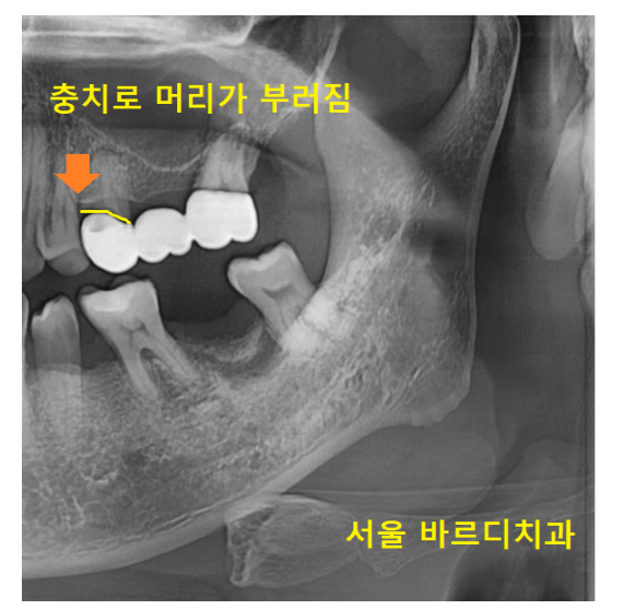 고덕역 근처 치과 브릿지와 임플란트 고민 중이신 분들 클릭하세요 관련 이미지 6