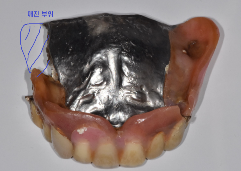 고덕역 치과 전체 치아 상실 시 자석 틀니 오버덴쳐가 해답이 될 수 있습니다. 관련 이미지 2