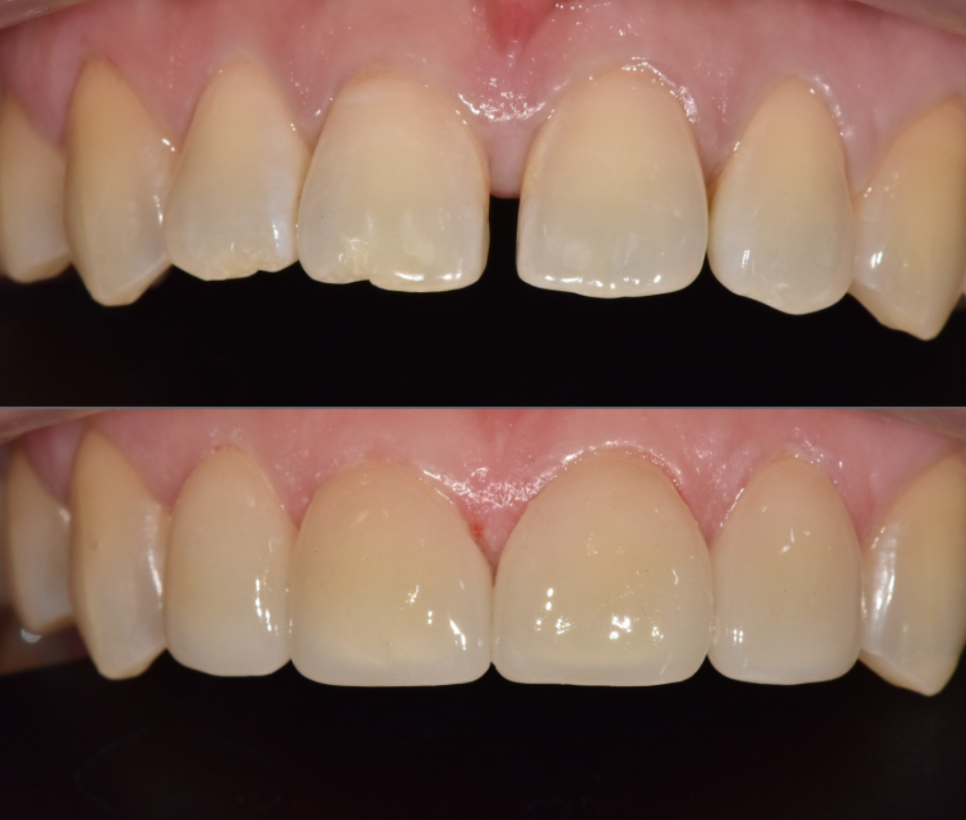 무삭제 라미네이트 적응증, 당신이 미처 몰랐던 시술의 조건을 공개합니다. 관련 이미지 12