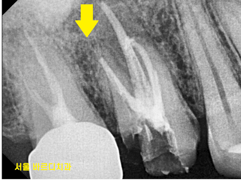 발치 대신 신경치료 뽑기 전 치료는 한번 해봐야하지않을까요? 관련 이미지 1