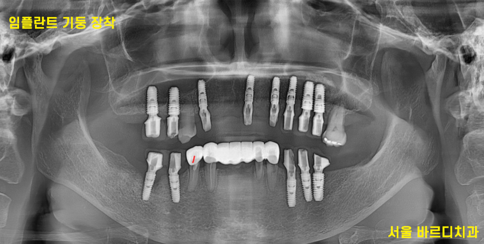 전체적인 치아 치료 13개의 임플란트를 식립한 환자분 관련 이미지 13