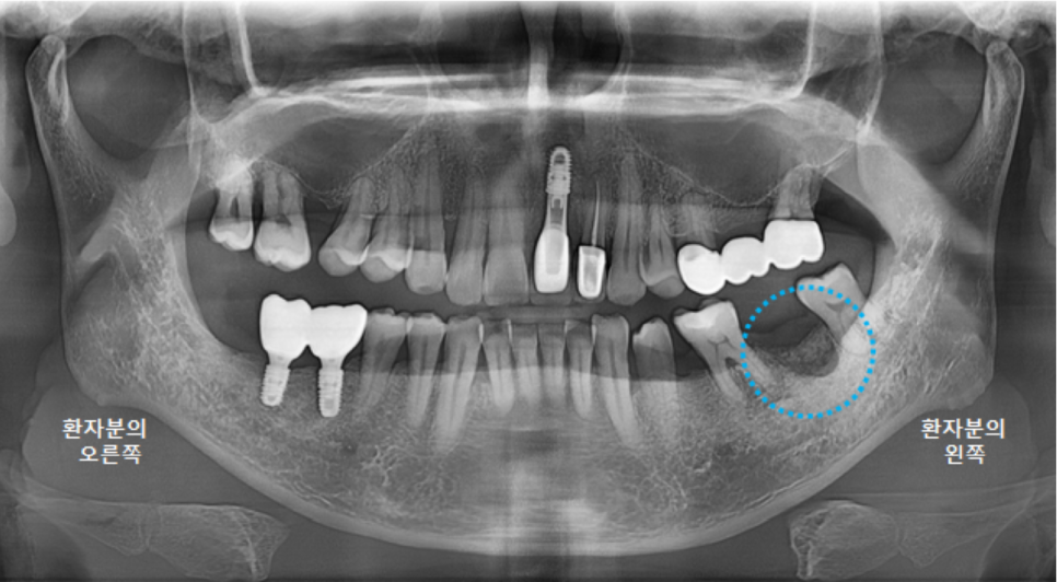 고덕동치과 서울바르디치과 전치부 및 구치부 임플란트 치료증례 #9 관련 이미지 10