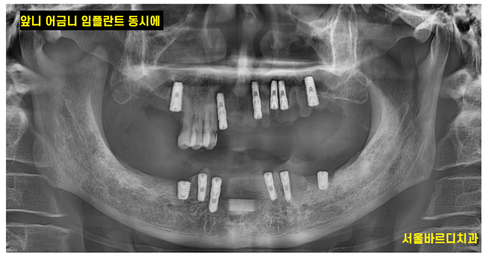 앞니 어금니 임플란트 동시에 진행할때 순서는? 관련 이미지 4