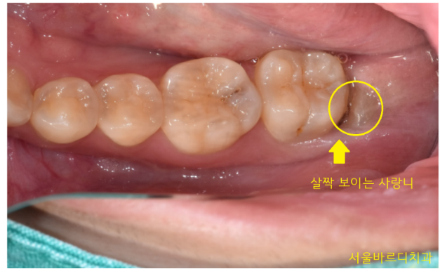 강동구 사랑니 묻혀있는 매복치아 꼼짝마!!! 뽑아줄테니까 관련 이미지 3