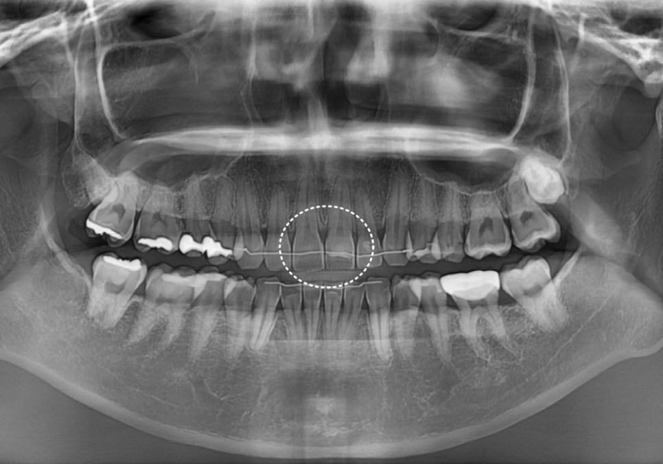 강일역 치과, 검게 보이는 앞니 레진 변색, 무조건 새로 해야 할까요? 관련 이미지 3
