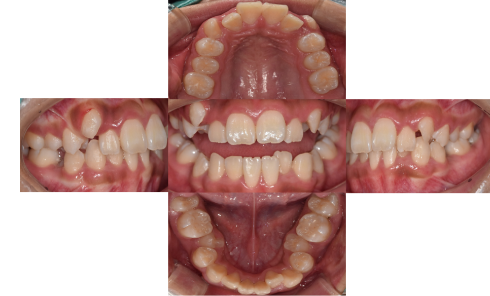 How to Correct a Canine Crowding Malocclusion: Extractions Are Necessary to Address Lip Protrusion image 4
