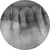 Restored 3 Teeth with Implants After Lower Front Teeth Became Loose and Fell Out image 3