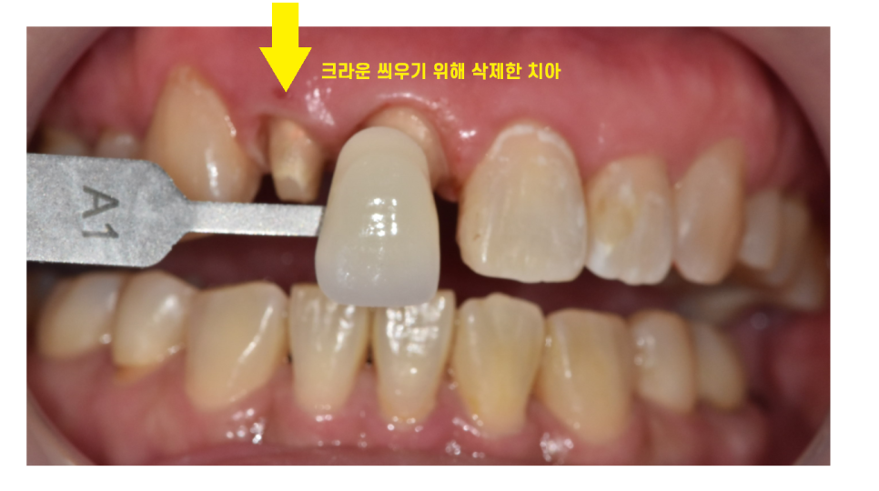 상일동 라미네이트 과연 진짜 안좋을까??? 교정, 크라운과 비교해보았습니다!! 관련 이미지 5