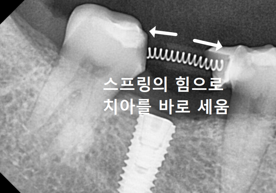 No space for an implant because a tooth has fallen over or a molar has tilted? Read this first. image 9