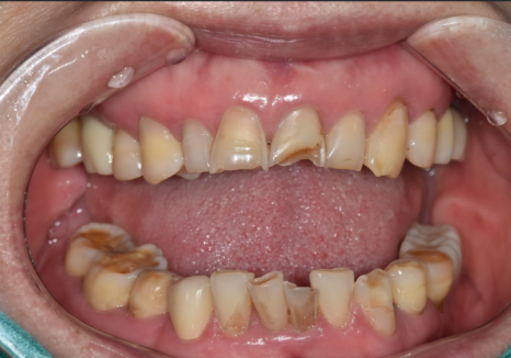 명일동 라미네이트 vs 크라운, 수명을 좌우하는 선택 기준 3가지 관련 이미지 11