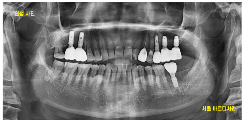 강일동 치과 전남 완도에서 올라오셔서 발치 후 당일 임플란트 완료하였습니다. 관련 이미지 8