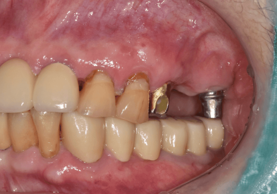 상일동 임플란트 심한 충치로 인한 치아 부러짐 해결한 사례 관련 이미지 1