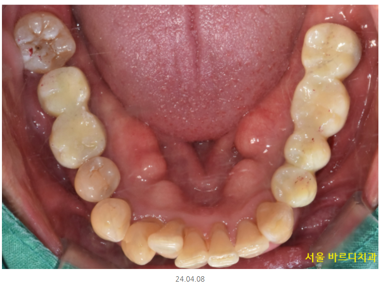 길동 치과 임플란트 뼈이식 흡연 관련 있을까? 관련 이미지 12